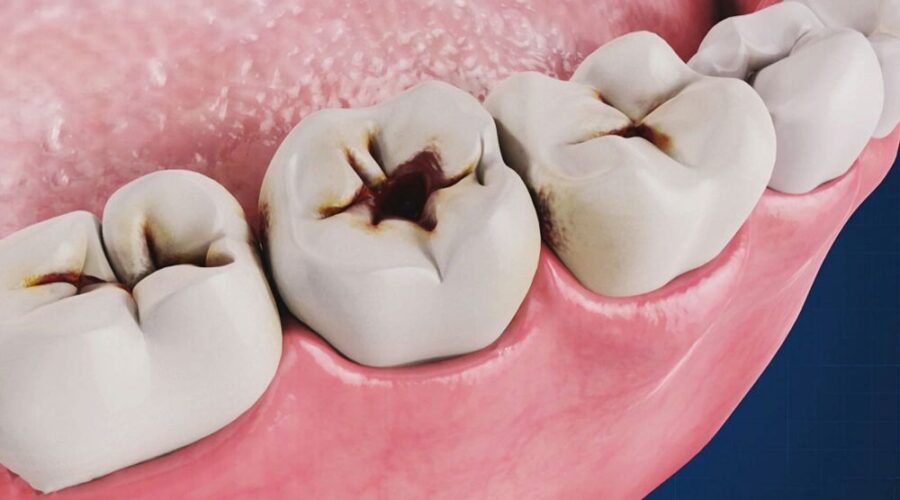 kenali risiko gigi berlubang